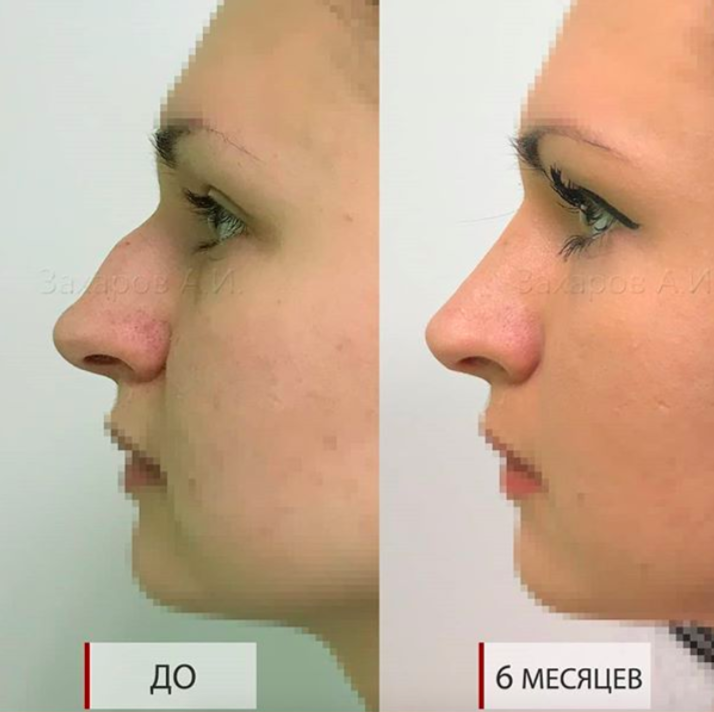Как выглядит нос через месяц после ринопластики. Реабилитация в первые недели после пластики носа