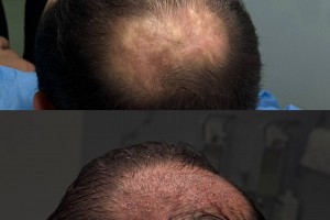 Пересадка волос в Медицинском центре «Здоровье» г.Брянск